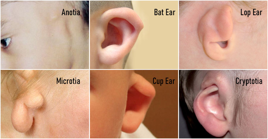 Types of Ear Deformities