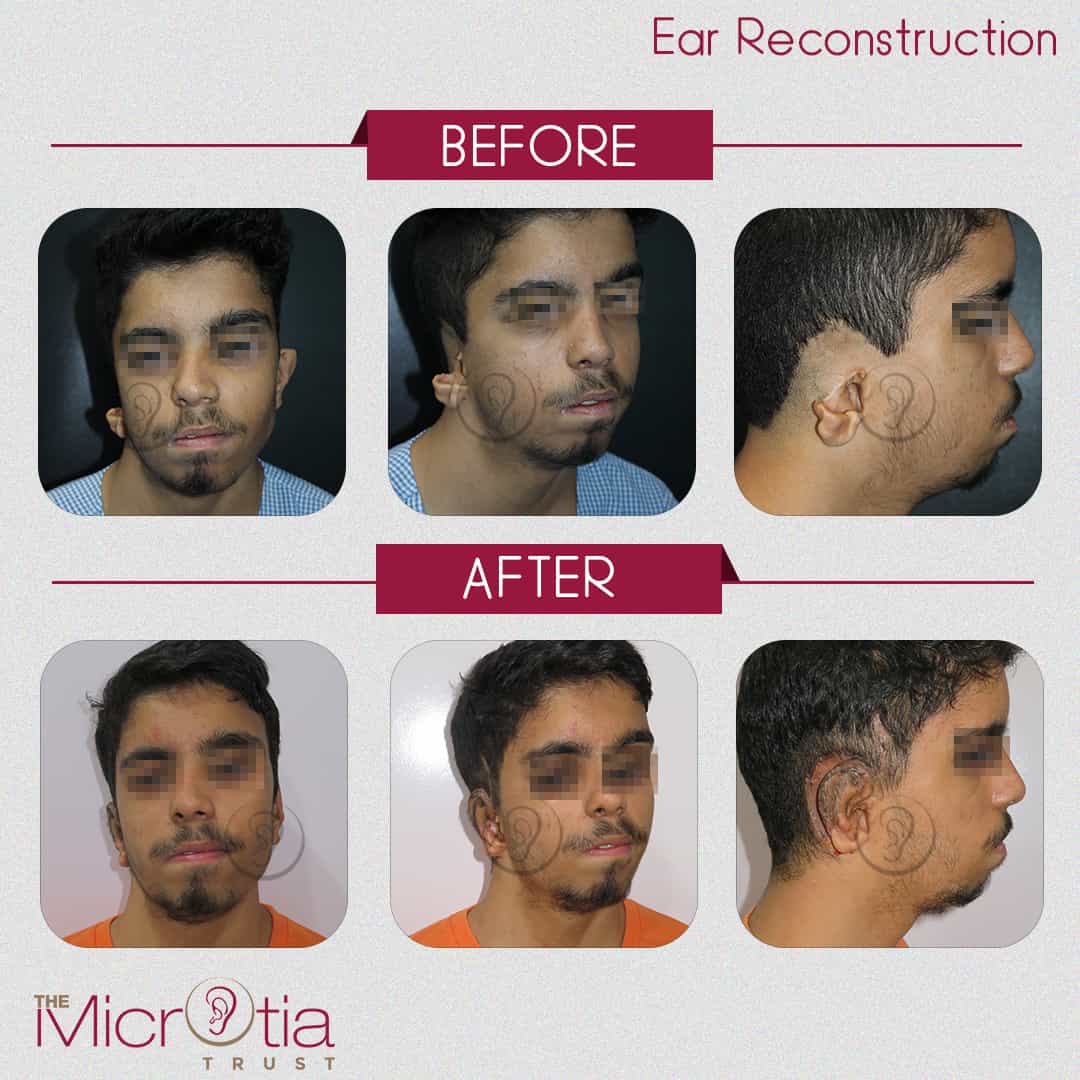 ear reconstruction surgery before and after