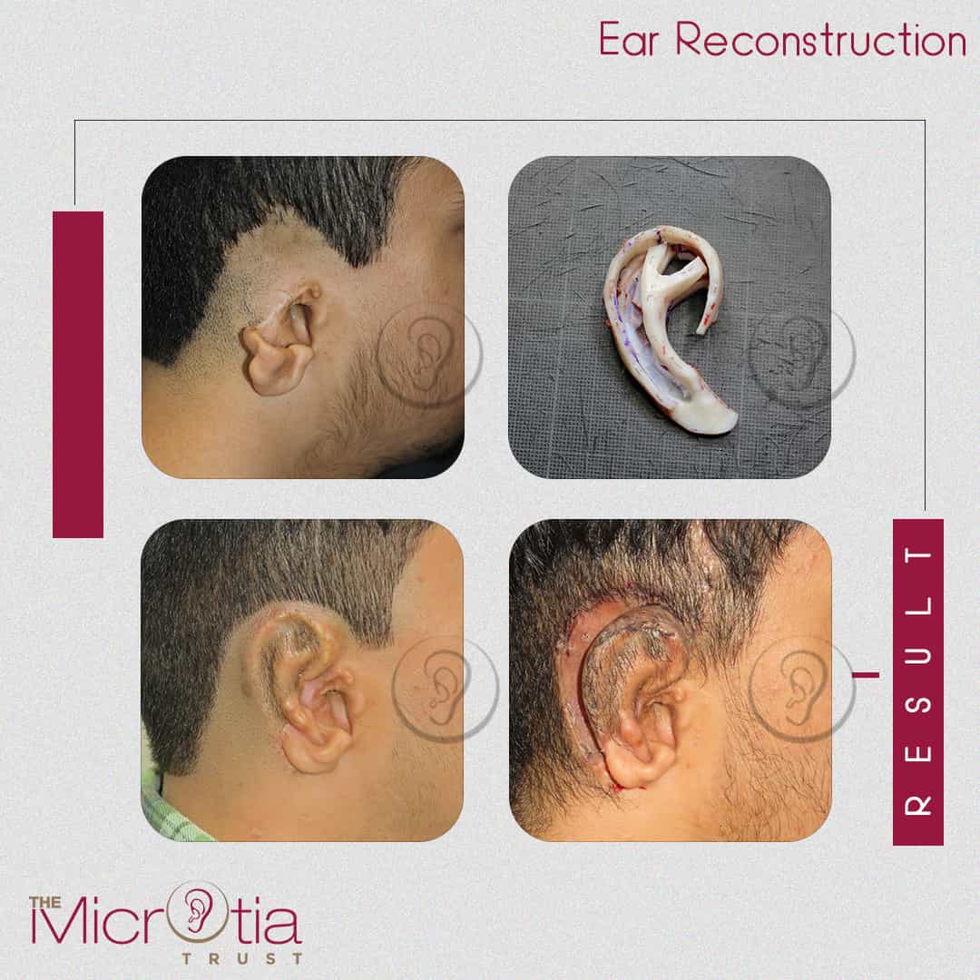 ear reconstruction surgery before and after