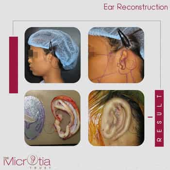 ear reconstruction surgery before and after
