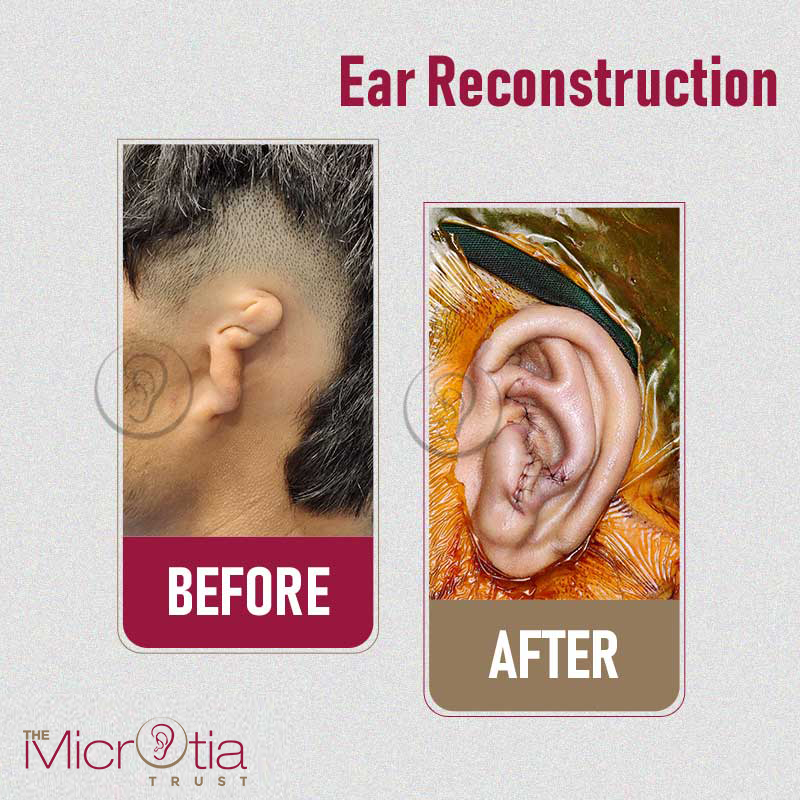 Ear Reconstruction Surgery