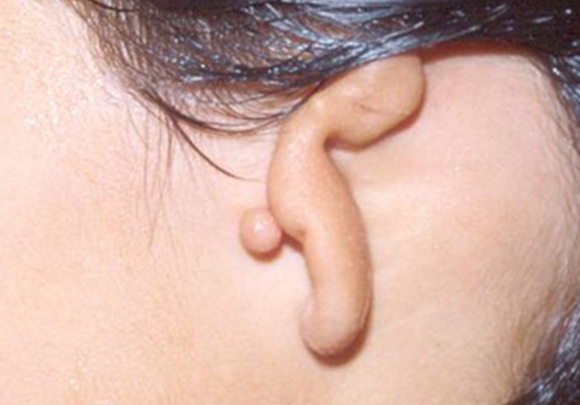 Ear Reconstruction Surgery in Mumbai